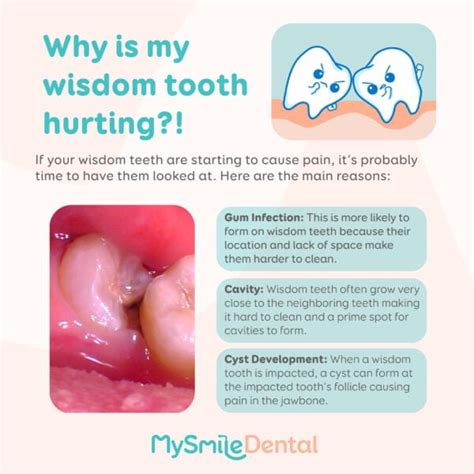 Wisdom teeth pain? - MySmile Dental Clinic