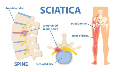 Sciatica and lumbar radiculopathy treatments