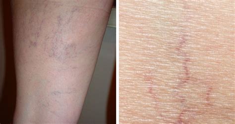 Causes of Spider Veins - Vein Solutions