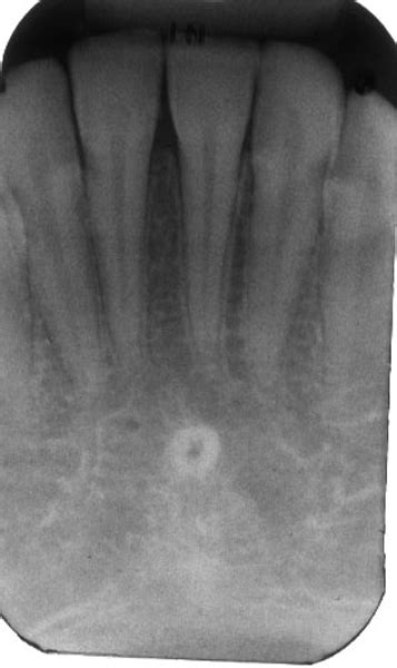 Lingual Foramen – Dr. G's Toothpix