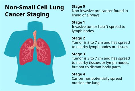 Stages Of Lung Cancer Diagram
