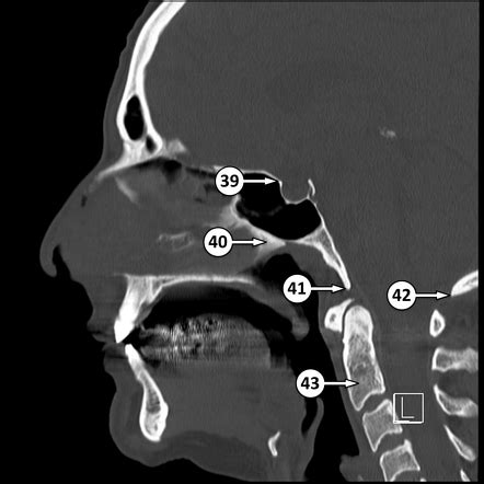 Tuberculum sellae | Radiology Reference Article | Radiopaedia.org