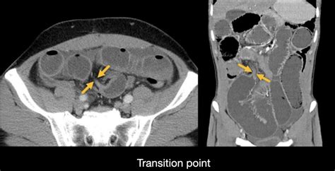 Abdominal CT: small bowel obstruction • LITFL • Radiology Library