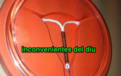 Inconvenientes del DIU de cobre • ConsultaTuGinecologo.com