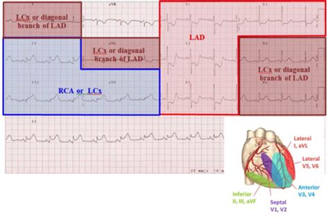 Coronary Arteries Positioning Of Ecg Leads Corresponding 12 Lead Ecg ...