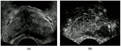 Transrectal Ultrasound Of Prostate