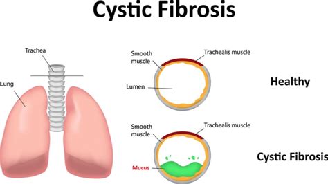 New Gene Therapy Could Treat Cystic Fibrosis With One Dose