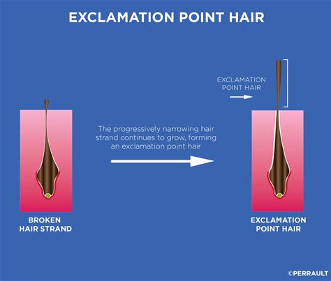 Anagen Effluvium | GL Perrault MD | Hair Loss and Hair Restoration