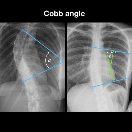 Cobb's Angle Scoliosis