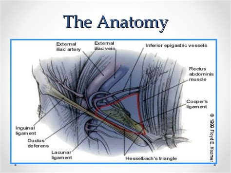 Inguinal hernia