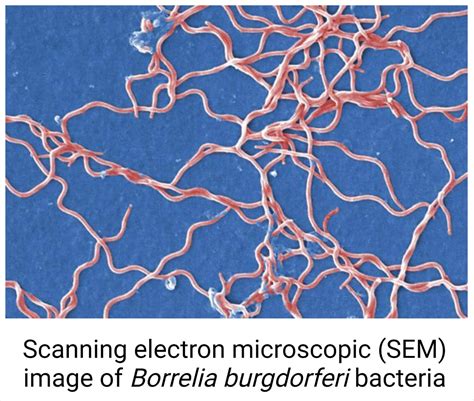 Borrelia burgdorferi (Lyme Disease)- An Overview