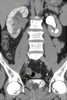 Acute Pyelonephritis-CT - Sumer's Radiology Blog