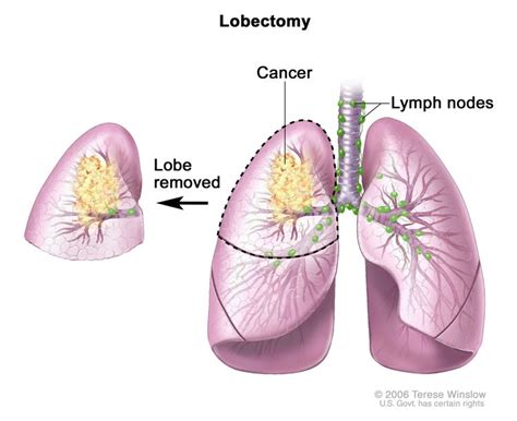 Non-Small Cell Lung Cancer Treatment - NCI