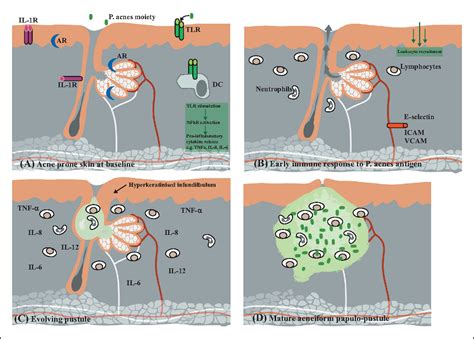 Pathways to inflammation: acne pathophysiology. | Semantic Scholar