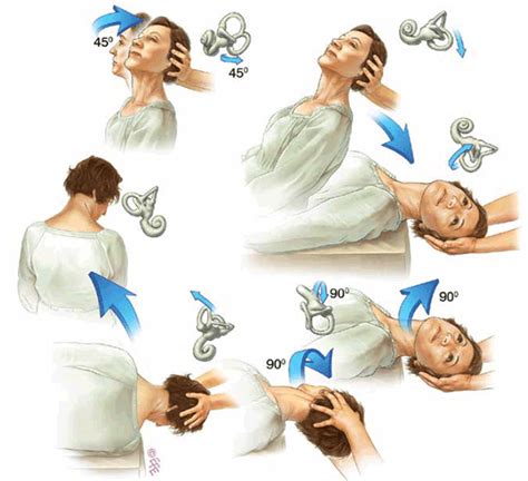 RACGP - The Epley manoeuvre for benign paroxysmal positional vertigo