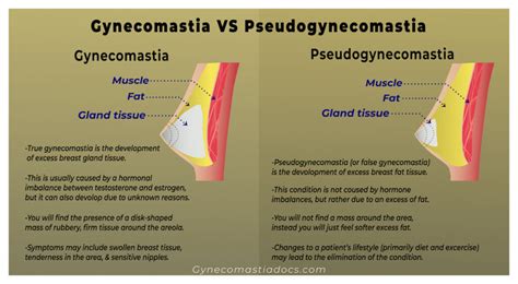 The Gynecomastia Pinch Test (What Is It and How Does it Work?)