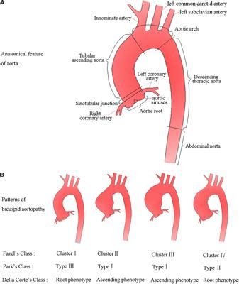 Frontiers | Aortic Dilatation in Patients With Bicuspid Aortic Valve
