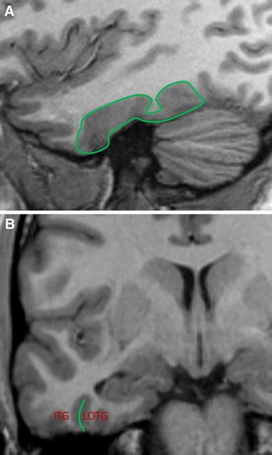 Collateral sulcus arc sign. The arc sign is outlined in purple ...