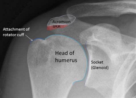 Treatment of Rotator Cuff Injuries - West Suburban Pain Relief