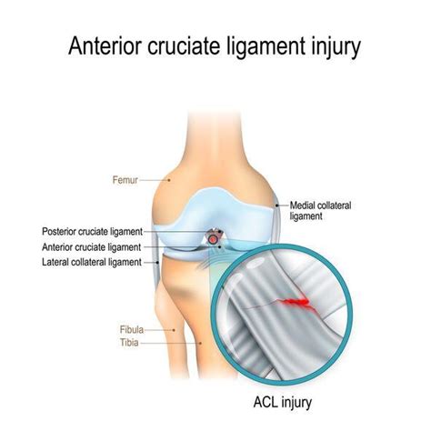 Torn ACL Symptoms - JOI Jacksonville Orthopaedic Institute