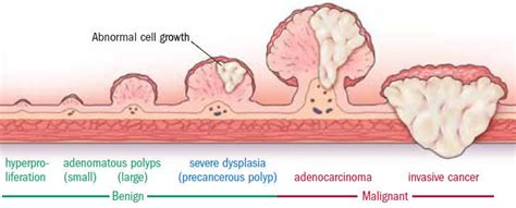 Colonic Polyps