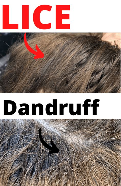 Lice vs Dandruff - 7 Key Differences Between Lice Eggs and Dandruff