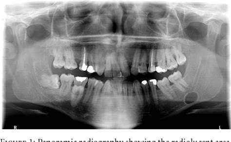 Figure 2 from Stafne Bone Defect: Report of Two Cases | Semantic Scholar