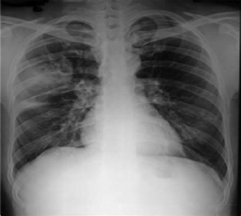 Chest radiograph of the same patient as in figure 1 taken 18 months... | Download Scientific Diagram