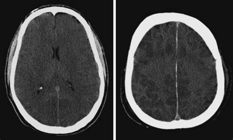 Hypoxic-Ischemic Brain Damage | Radiology Key