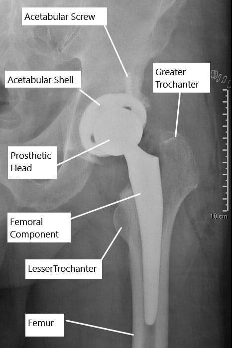 Uncemented Vs Cemented Total Hip Replacement | Complete Orthopedics