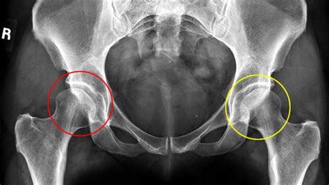 Hip Dysplasia in Babies - Lopinion - GLBrain.com