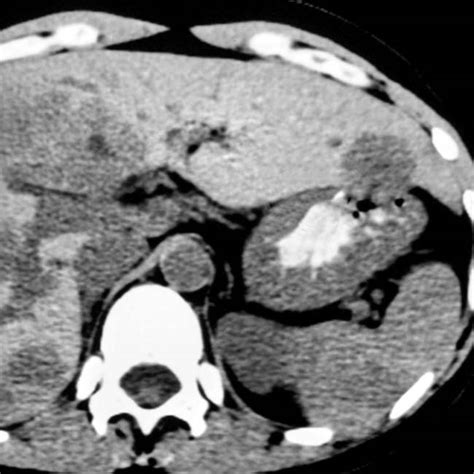 Zollinger-Ellison Syndrome | Clinical Gate