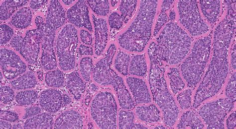 Cylindroma | MyPathologyReport.ca