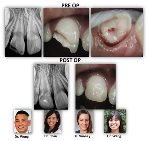 Dental Trauma: Preserving Healthy Pulp Tissue | Renovo Endodontic Studio