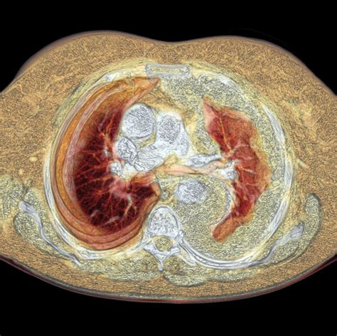 Lung Cancer, Ct Scan Photograph by Du Cane Medical Imaging Ltd - Pixels