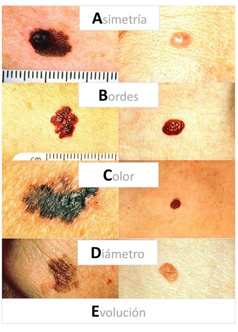 abcde melanoma | Doctora Lorea Bagazgoitia Dermatología