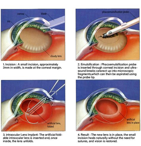 Best Eye Hospital for Cataract Surgery | Dr Rohan's Eye Hospital