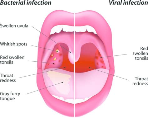 Sore Throat: Symptoms, Causes, Treatment, and Diagnosis | FindATopDoc