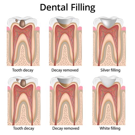 Cavity Filling vs. Root Canal - Two Main Difference - Dental Pickup