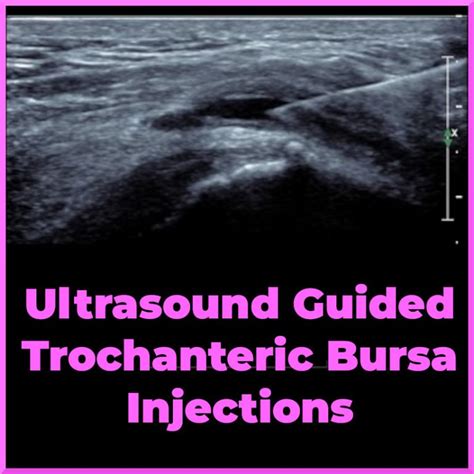 Trochanteric Bursa Injection: Ultrasound- Sports Medicine Review