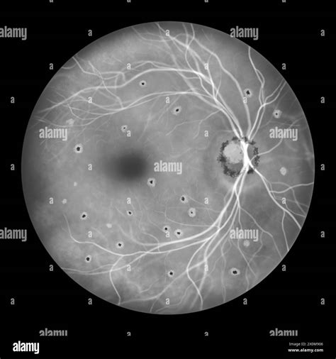 Illustration of a retina affected by presumed ocular histoplasmosis syndrome as seen in ...