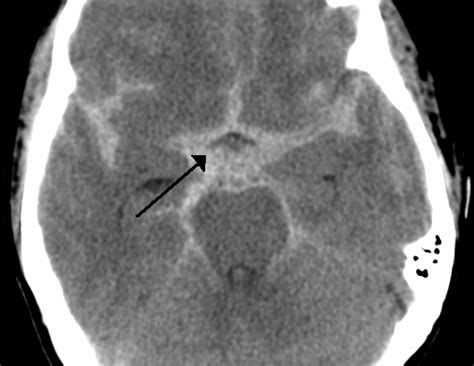 Subarachnoid Hemorrhage | RECAPEM