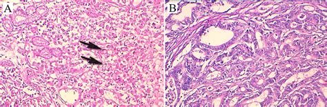 Meddele Inspektion Store gastric signet ring cell carcinoma ...