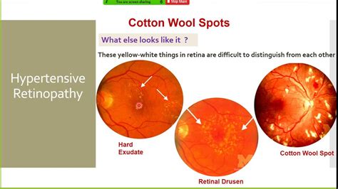 Hypertensive Retinopathy Symptoms