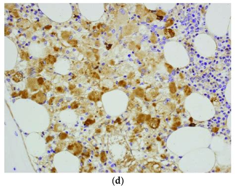 (a) Trephine biopsy-bone marrow occupied by the sheets of abnormal... | Download Scientific Diagram