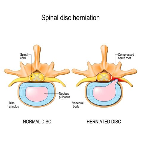 Non-Surgical Treatments for Herniated Discs - Texas Spine Clinic