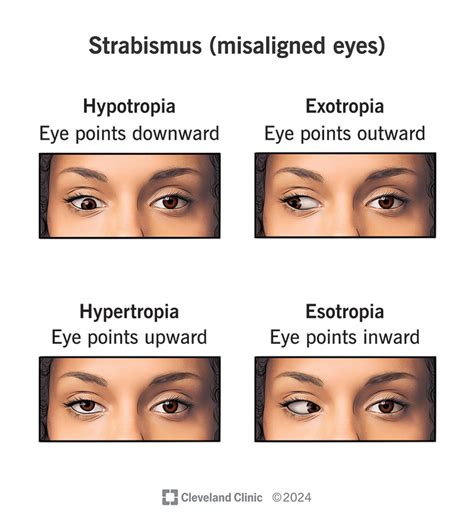 Strabismus (Eye Misalignment): Symptoms, Causes & Treatment