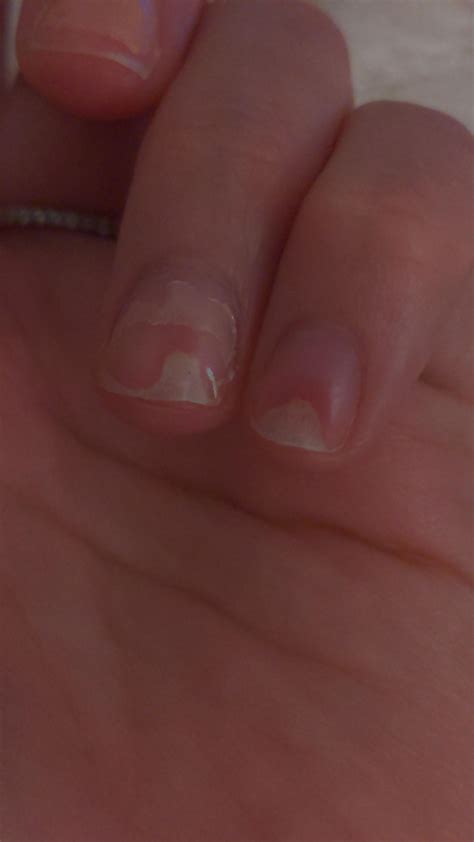 Damaged Nail Bed - Happened after Acrylics were removed. Tips on ...