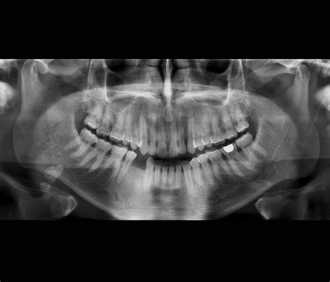 Salivary Gland Stone, X-ray Photograph by Science Photo Library