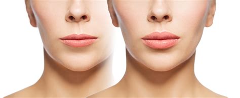 Fuller Lips without Needles: Lasers Make it Possible